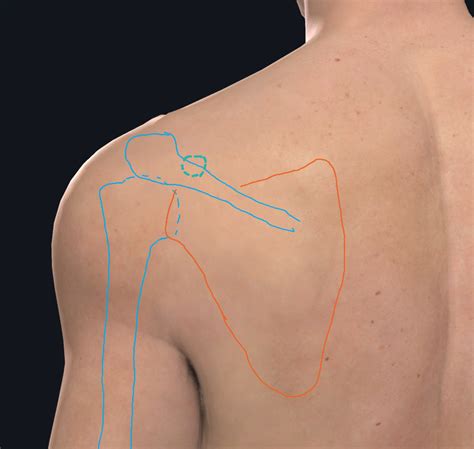 test for pec major tear|major tear in pectoralis.